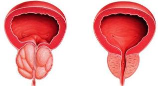 the difference is the patient and the healthy prostate